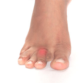 Hammer Toes Information and Treatment 