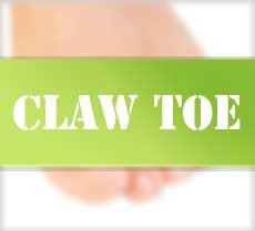 claw toes
