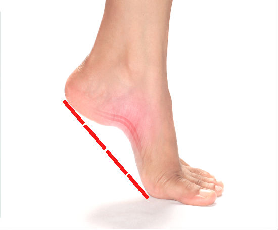 How Do I Know if I Have Flat Feet?