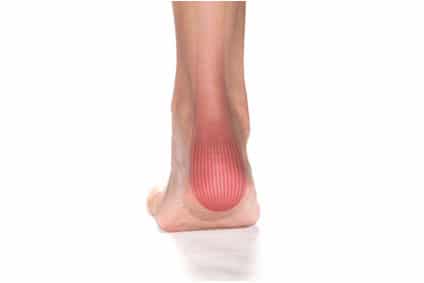 What Is Achilles Tendonitis? | Foot Solutions Ireland